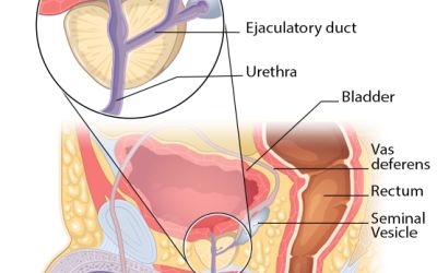 Vasectomy may increase risk of aggressive prostate cancer